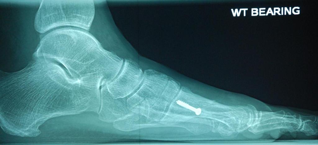 Case L (Figure 2): Lateral radiograph of 2 nd and 3 rd metatarsal