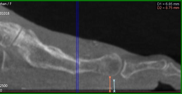 PedCat CBCT Findings: (Figures 3, 4 and 5) The sagittal plane weight bearing reconstruction images, in addition to the DICOM viewing software, allow for measurements from the weight bearing surface