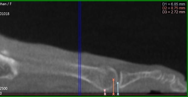 Case L (Figure 5): PedCat CBCT sagittal plane reconstruction view of the 4 th metatarsal position to the ground.