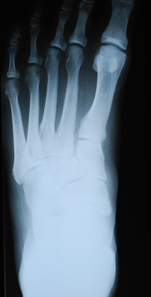 Case M (Figure 1): AP x-ray preoperative planning for midfoot fusion. Case M (Figure 2): Lateral x-ray preoperative planning for midfoot fusion.