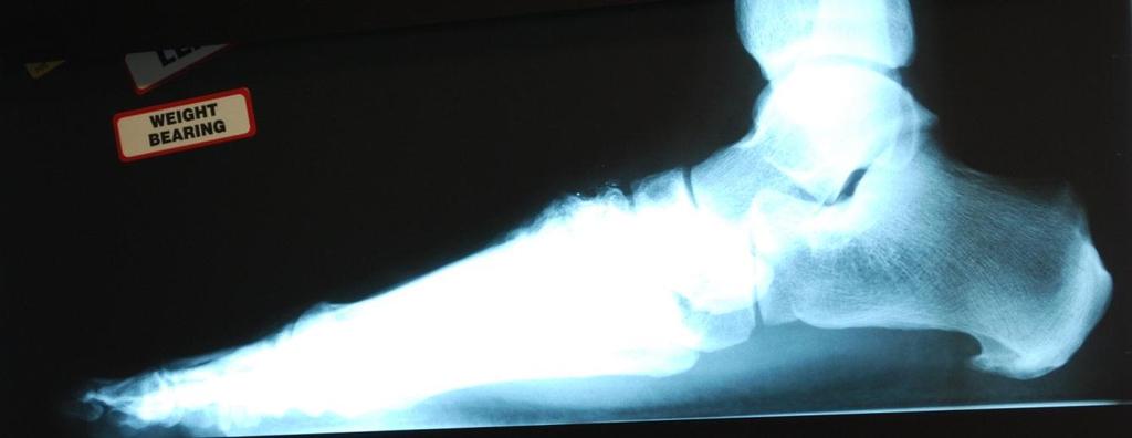 irregular joint space. The 3-D view also demonstrates arthritic changes to the third tarsometatarsal joint.