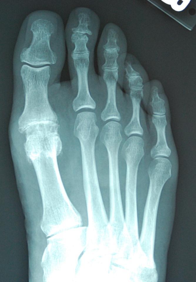 Case N (Figure 1): AP x-ray of arthritic great toe joint.