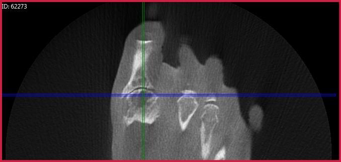 Case N (Figure 3): PedCat CBCT transverse plane reconstructions demonstrating bone cysts in the first metatarsal head and proximal phalangeal base.
