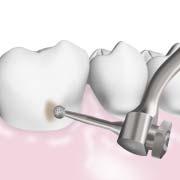 RSTORATIV ( V-Tip) For Minimal Intervention The Varios V-Tip System has been developed to meet Minimal Intervention dental procedures.