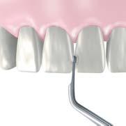 9 62D Z217-602 27.6 7.7 66D Z217-606 65D For molar, interdental proximal caries.