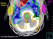 Radiation Therapy 28 Systems Image courtesy of Philips