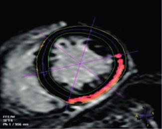Epicardial unipolar mapping better identifies the corresponding CMR-detected scar and encloses the LP area that was targeted for ablation.
