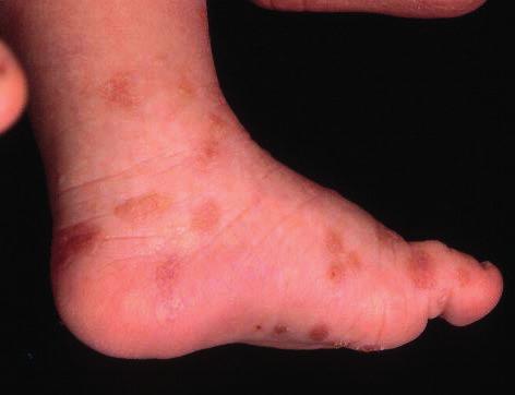 14 Fig. 9 Healing skin lesions at the age of 3 months.