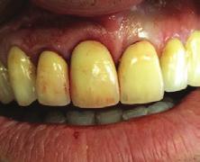 teeth and 3 mm between implants