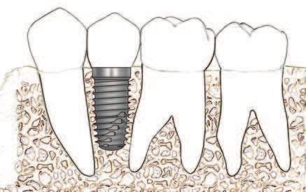 These include: Altering Drilling Guidelines The drilling protocol determines the fit of the implant