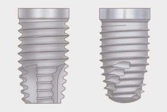 Although osteotomies for parallel-walled implants traditionally have utilized a final drill that is