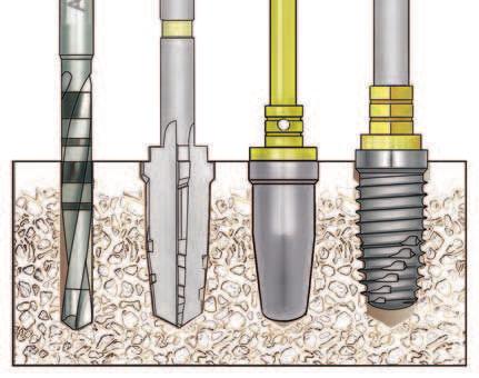 A tapered implant may better accommodate the surgical space when converging roots are present. Tapered implants may be ideally suited in those clinical situations where facial concavities are present.
