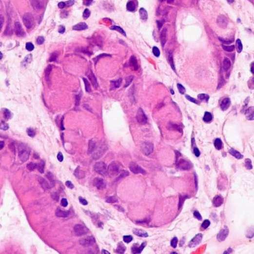 In situ (signet ring cell) carcinoma Pagetoid