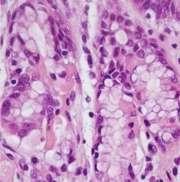hyperplasia In situ signet ring cell