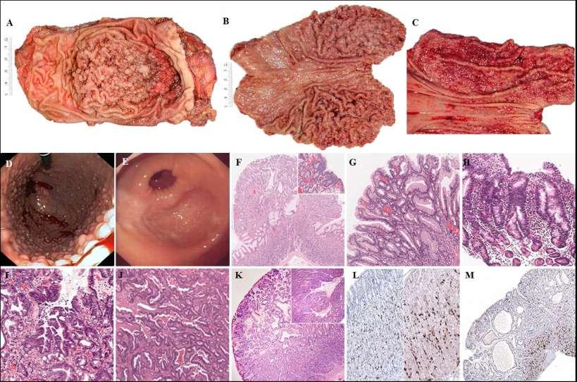 New Hereditary Gastric Cancer Syndrome: Gastric Adenocarcinoma and Proximal