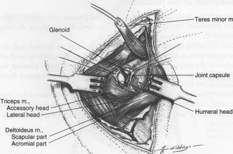 suturing of the infraspinatus tendon Closure may