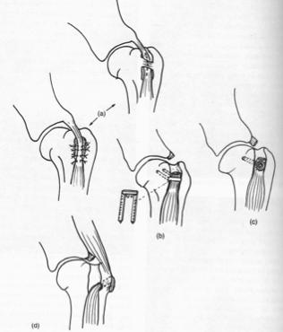 Section tendon a/a and pass through a bone tunnel in greater tubercle and attach to supraspinatus attachment Forelimb surgeries l Osteochondritis Dissicans Note: in some cases lameness may resolve