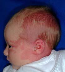 Angels Kiss birthmark B. Birth trauma C. Capillary malformation/port wine stain D. Infantile hemangioma E.