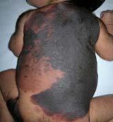 Café au lait macule (CALMs are well demarcated, light brown, flat lesions with no hair) B. Congenital melanocytic nevus C. Dermal melanocytosis (ill defined, blue gray patches, resembling a bruise) D.
