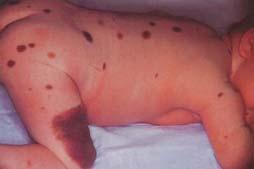 Epidermal nevus (raised tan or brown linear birthmarks due to overgrowth of the epidermis, usually become verrucous with time) Congenital Melanocytic Nevi: Clinical Proliferations of benign