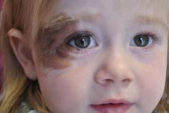 CMN: Prognosis and Treatment Other benign pigmented birthmarks Treatment depends on age of the patient, size of nevus, location, family preference.