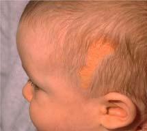 Seborrheic dermatitis (erythematous and scaly plaques often seen on the scalp and face) Nevus Sebaceus or organoid hamartoma 0.