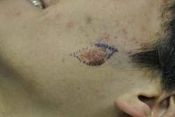 Nevus Sebaceus: Management Usually diagnosed clinically, based on history and clinical