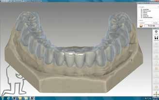 Splint Tool Additional Software Module* All relevant patient data is gathered conventionally or with the zebris Functional Jaw Movement Analysis.