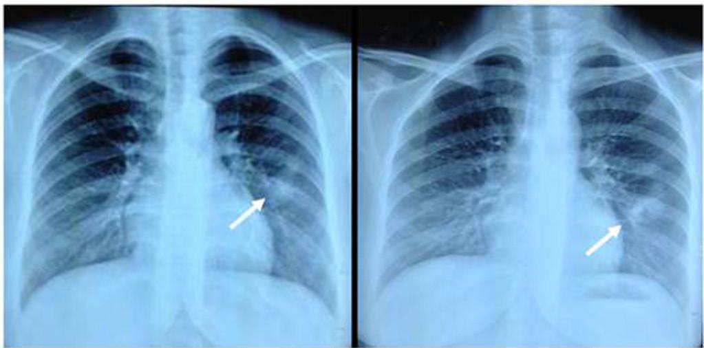 Southeast Asian J Trop Med Public Health A Fig 1 (A) A chest radiograph showing a round opacity in the left lower lobe of the lung; (B) a chest X-ray taken 12 days after X-ray (A) with an increase in