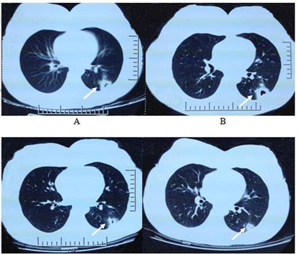 A B C Fig 2 (A) The initial chest CT scan showing two pulmonary nodules, one with cavitation (white arrow).