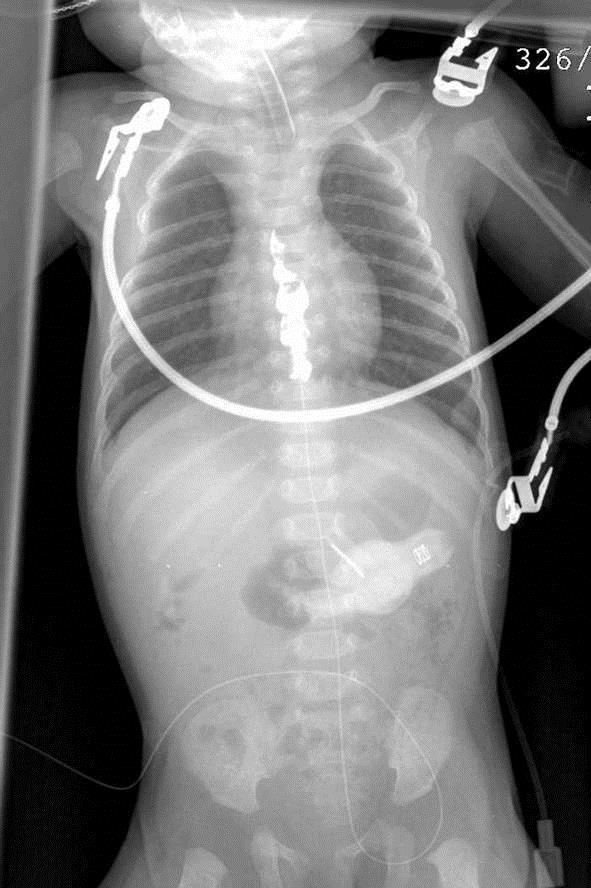 Epidural Analgesia Caudal or lumbar Thoracic direct, or threaded from caudal space Local anesthetic + opiate Time- &