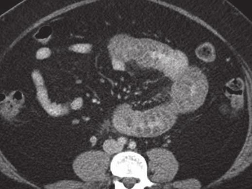 MDCT of Visceral ngioedema Fig.