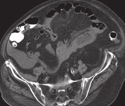 , Image shows stratified appearance of small-bowel wall (i.e., increased attenuation of serosa compared with submucosa) with mild ascites.