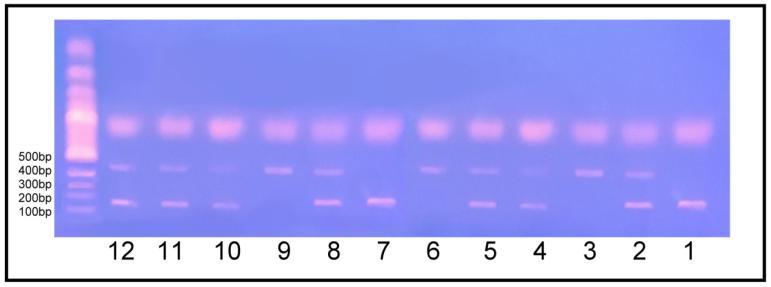 Figure 4: CR product of DNA analyzed by agarose gel electrophoresis. DNA was extracted from blood, The CR product was electrophoresed on 2% agarose (75V and 120 min.