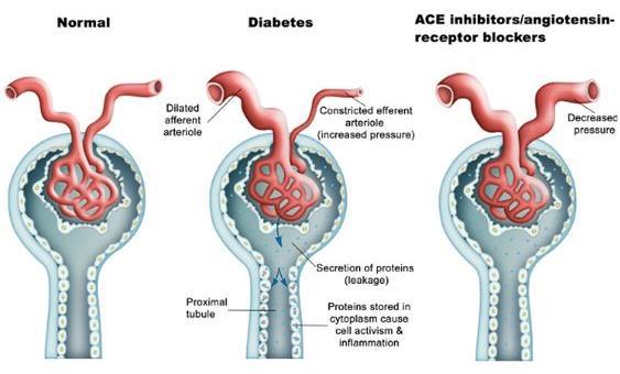 MEDICAL USE FOR ACE-Inhibitors NEPHROPATHY by HYPERTENSION or DIABETES ACE- I are effective in slowering renal disease by diabetes or hypertension