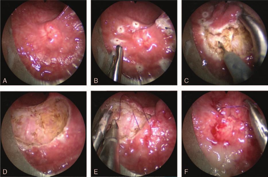 www.md-journal.com Figure 3. Details of the tumor resection by transanal endoscopic microsurgery.