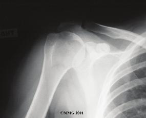 (Don't worry. Unless your shoulder is extremely loose, it will not dislocate.) Your doctor may order an X-ray. X-rays can help confirm that your shoulder was dislocated or injured in the past.