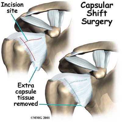 Almost all of these operations attempt to tighten the ligaments that are loose. The loose ligaments are usually along the front or bottom part of the shoulder capsule.