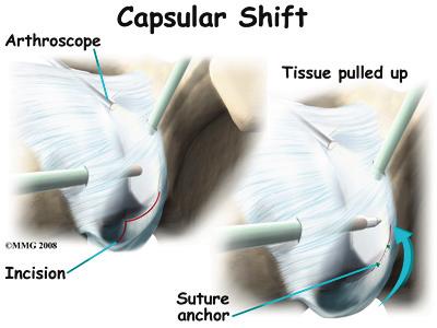 The joint capsule forms a pocket, or bag that is made up of the ligaments and connective tissue around the joint.