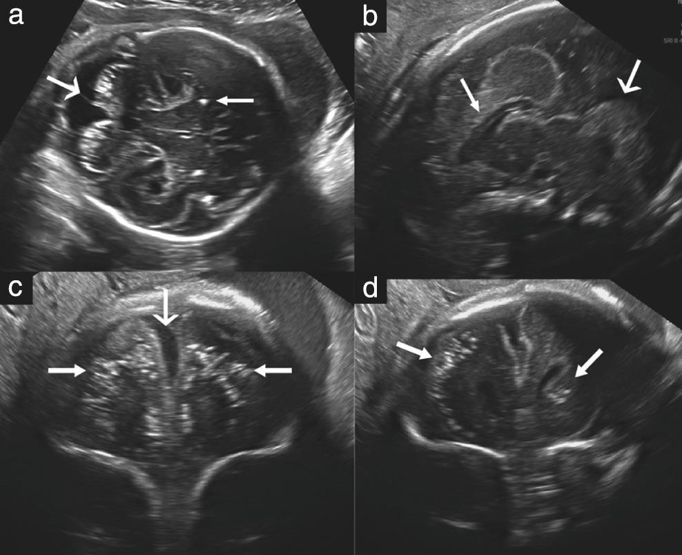 Zika virus intrauterine infection causes fetal brain abnormality and microcephaly: tip of the iceberg?