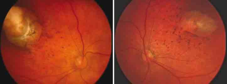 Fetal/Neonatal effects Eye abnormalities 29 infants with microcephaly in Brazil 35% had ocular abnormalities