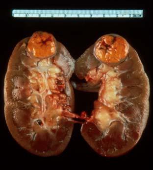 Typical kidney cancer =Renal cell carcinoma Kidney Cancer Diagnosis-It s all