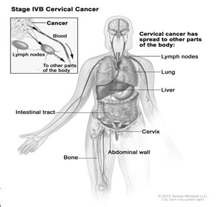 Cervix Uteri M1 Corpus Uteri N2 N1 Sacral/ Parasacral Para-aortic Common Iliac External Iliac