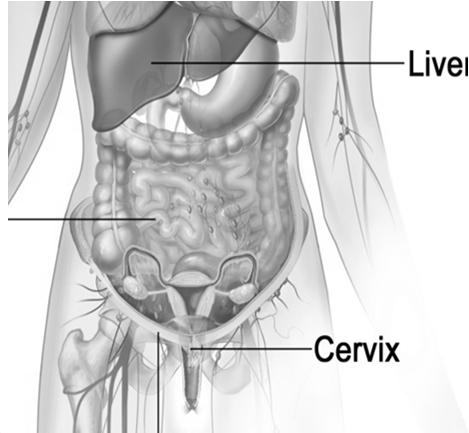imageid=1770 19 DISTANT METASTASIS Cervix Para-aortic lymph nodes Mediastinal lymph nodes Lung