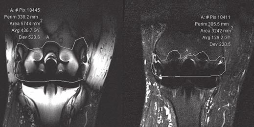 Ulbrich et al. A B Fig. 2 Extent of artifacts (signal void). A, 59-year-old man after knee arthroplasty.