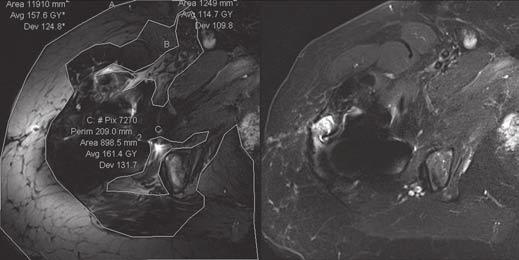 B, 76-year-old woman after hip arthroplasty. STIR image (left) shows almost completely insufficient fat suppression. STIR optimized inversion pulse image shows normal fat suppression.