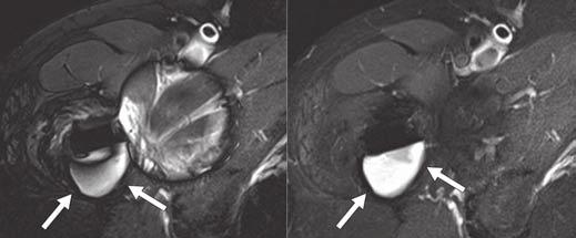 Artifact Reduction in MRI A B Fig. 3 Clinical findings in two patients after hip arthroplasty. A, 58-year-old woman with joint effusion in hip after arthroplasty.
