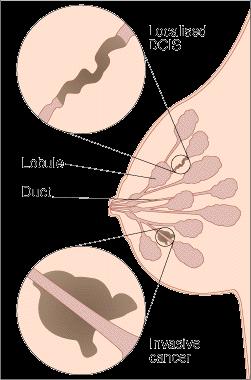 Types of breast cancer: DCIS-Ductal carcinoma in