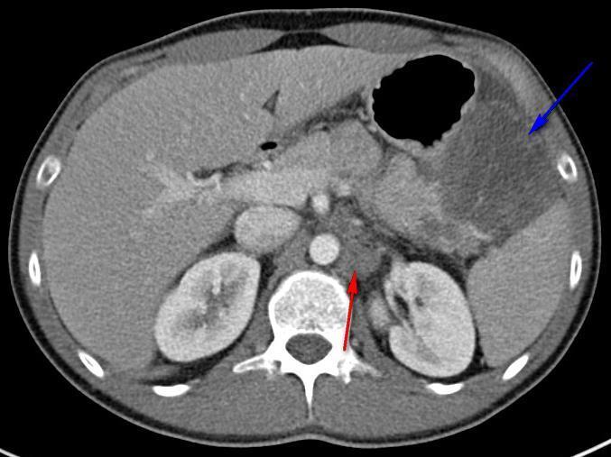 Figure 2: 27 year old male with Desmoplastic Small Round Findings: Abdominal CT with hypodense, mesenteric mass
