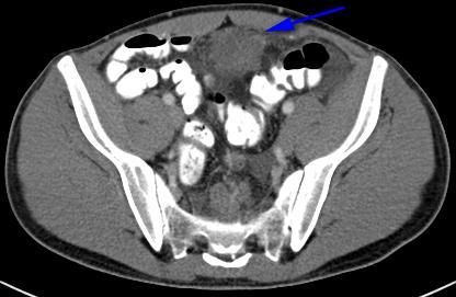 involving the small bowel, likely related to bowel inflammation or nonvisualized peritoneal involvement.